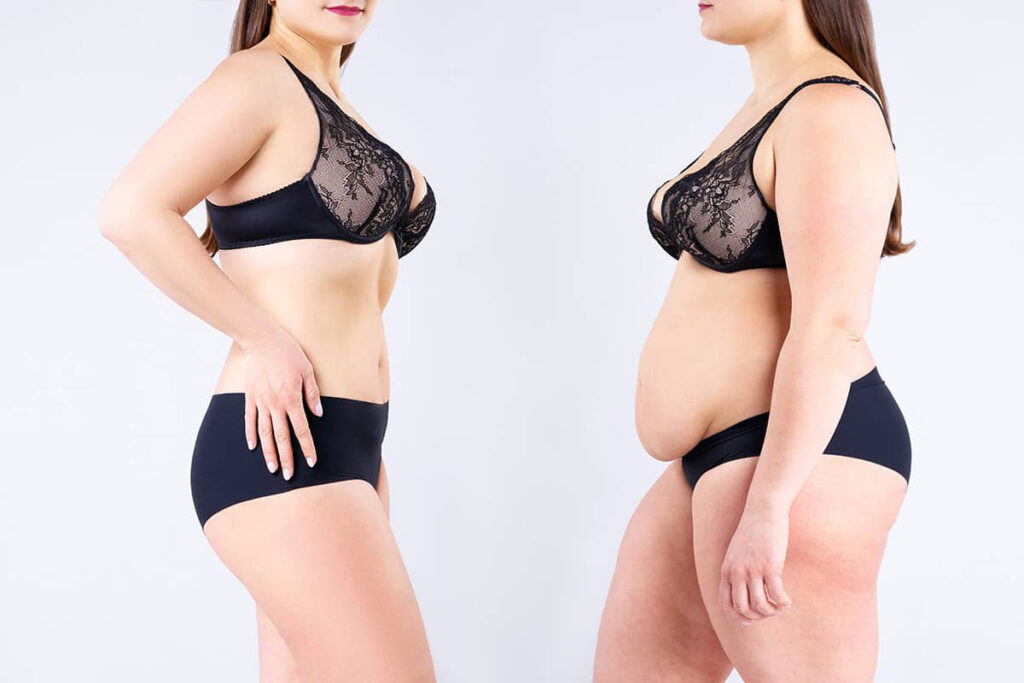 The Real Value of Weight Loss Surgery